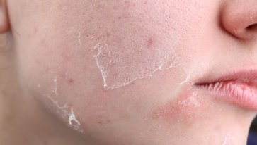 Pelle secca e screpolata con i primi freddi: consigli utili