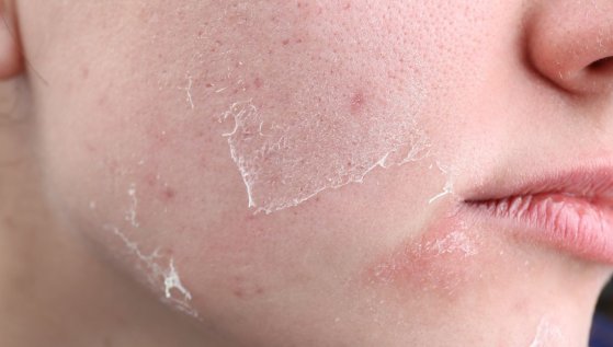 Pelle secca e screpolata con i primi freddi: consigli utili Pelle secca e screpolata con i primi freddi: consigli utili